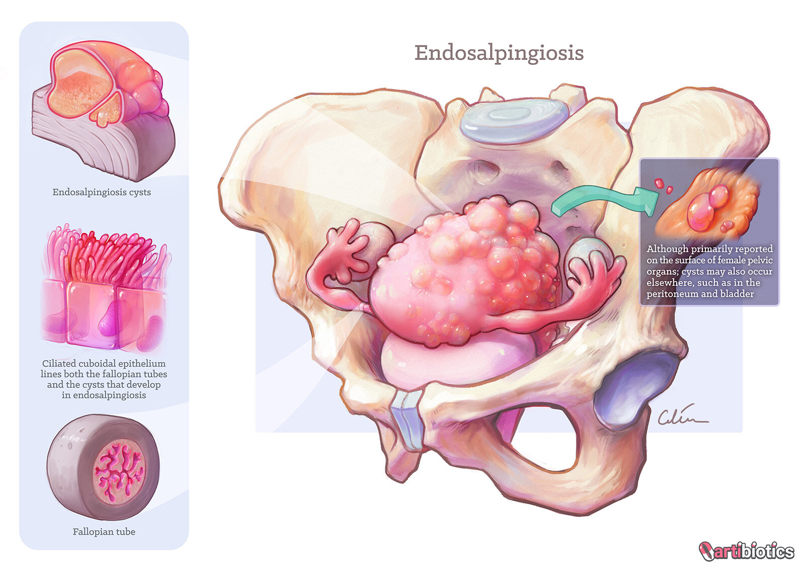 Endosalpingiosis by Dr Cilein Kearns Artibiotics v07b 72dpi 1600px logo.jpg