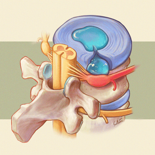 Disc prolapse