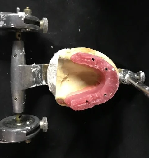 ImplantWaxRim.jpg