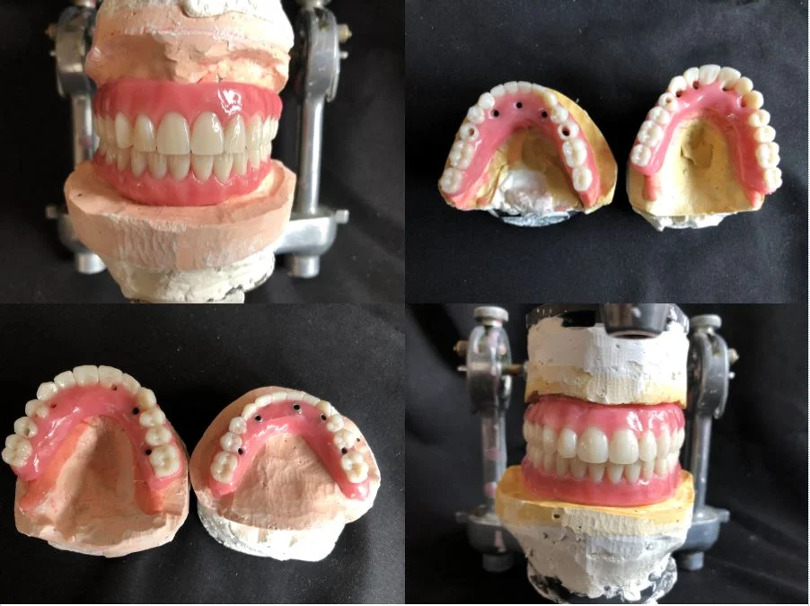So nice, we did it twice! Procera Implant Bridge hybrids