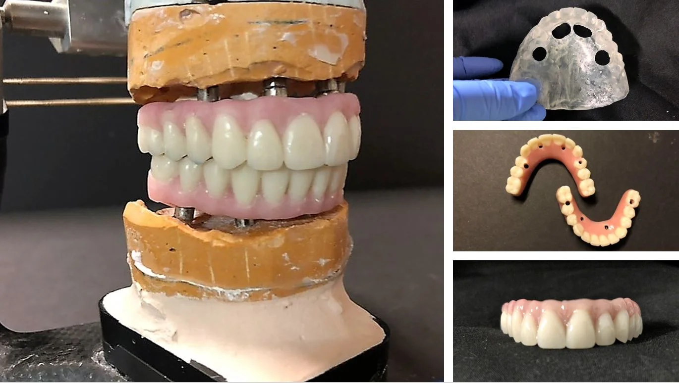 More All-On-X Surgery Cases!