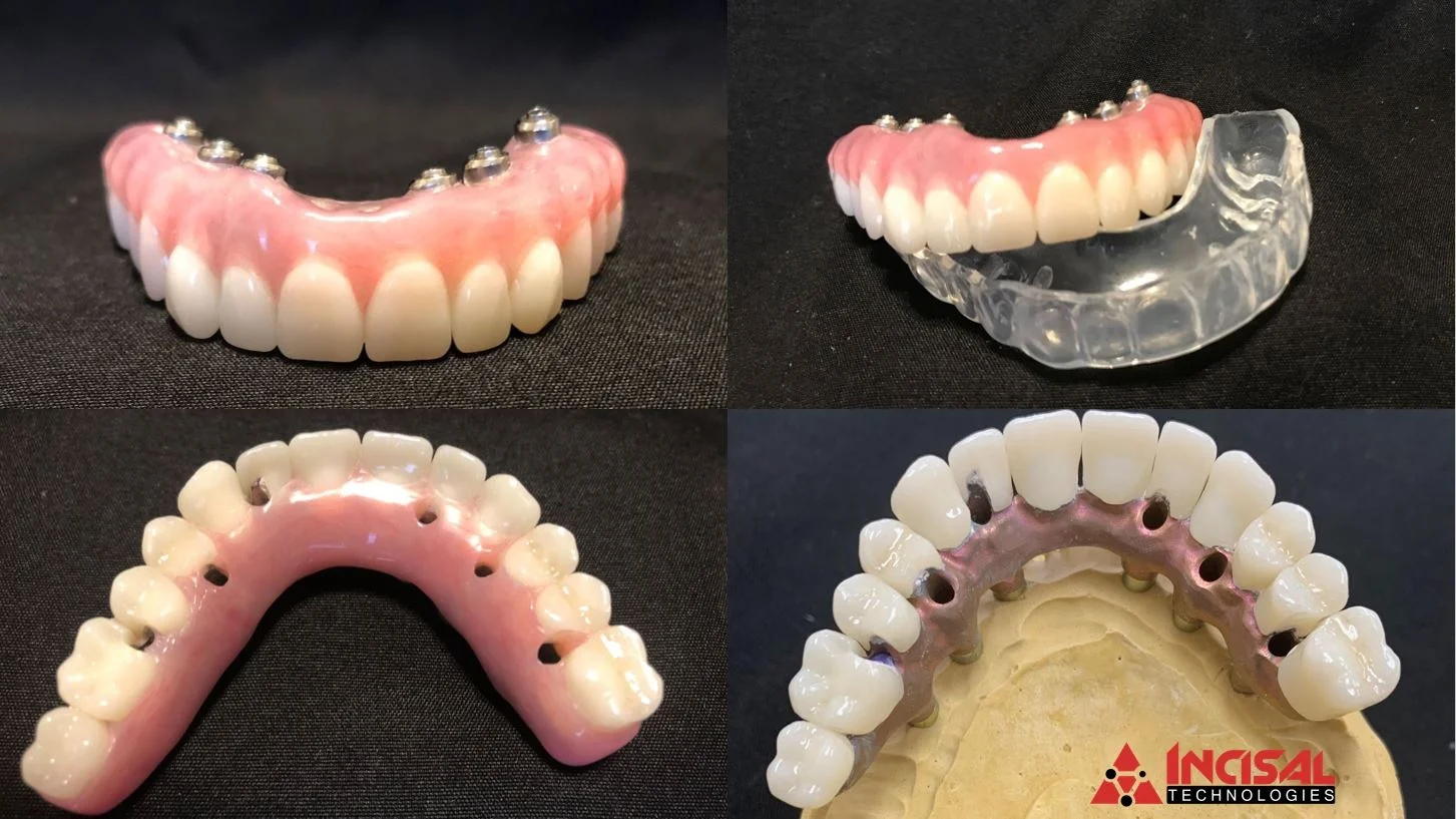 Another Successful Procera Implant Bridge (PIB) Case Delivery
