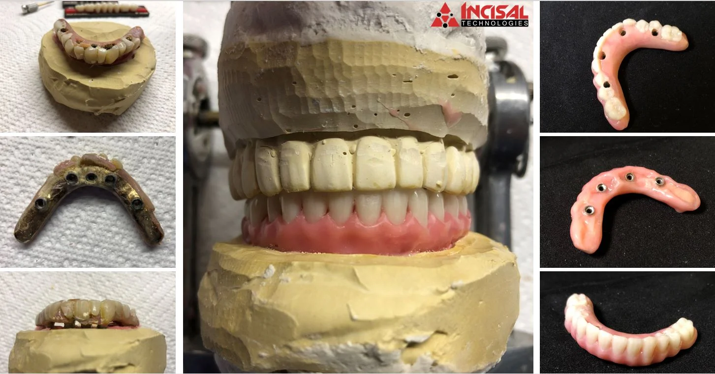 20+ Year Old Hybrid - Reline and Tooth Replacement