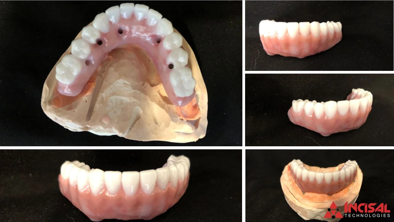 Fully Milled Zirconia on Biohorizon Implants