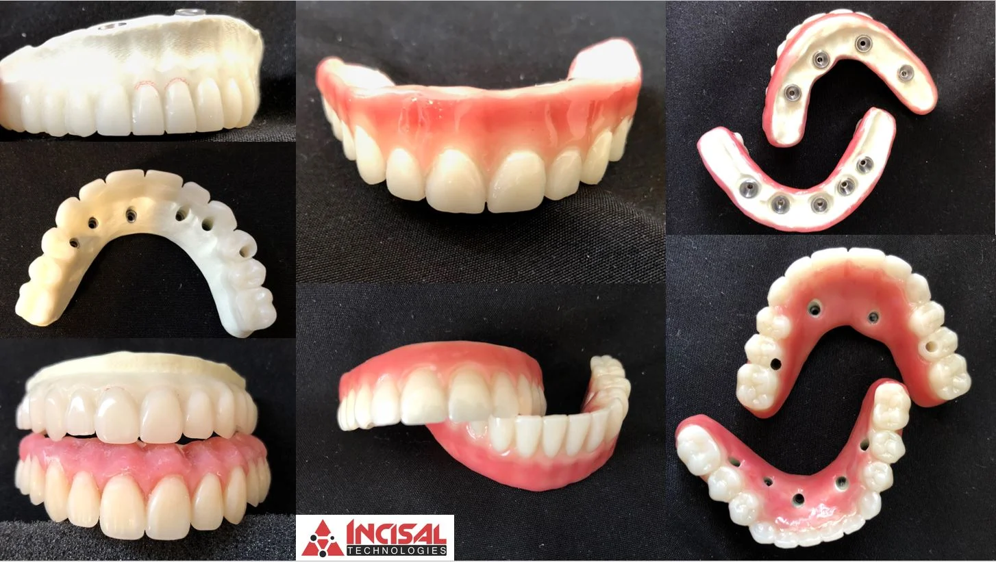 Anaxdent Tissue on PMMA Over a TriLor Bar