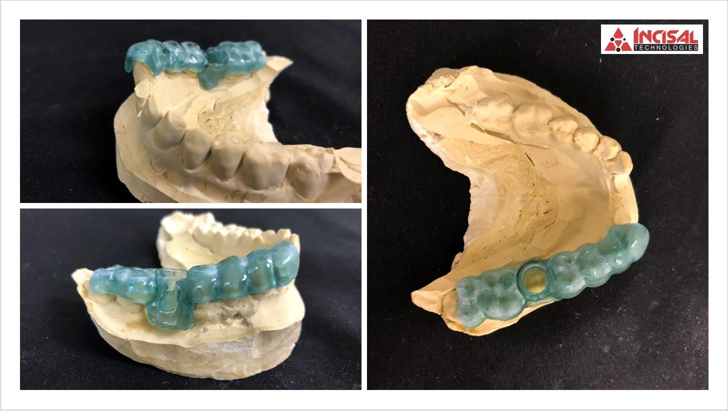 3D Printed Single Unit Surgical Guides