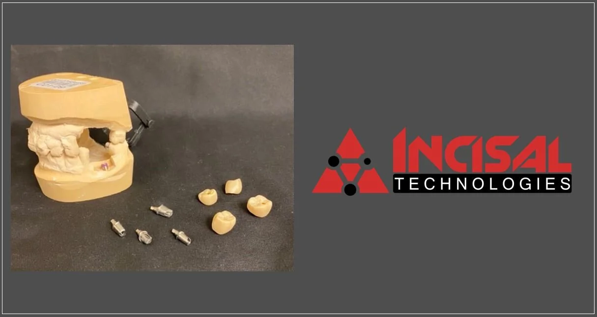 Crowns over Custom Abutments