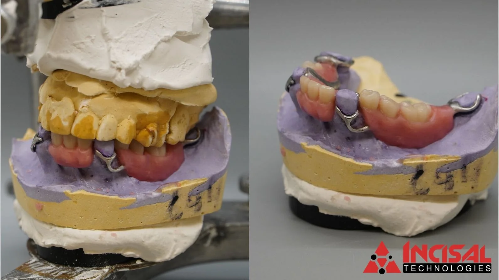 Partial Dentures