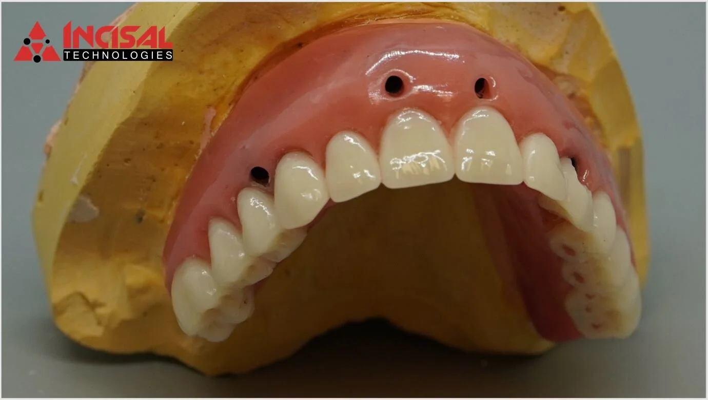 No Room for Angled Abutments - Unique Treatment Planning