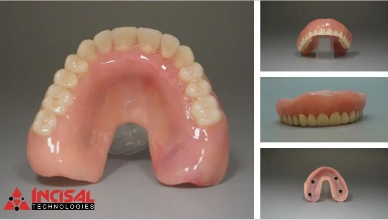 Acrylic Locator Denture