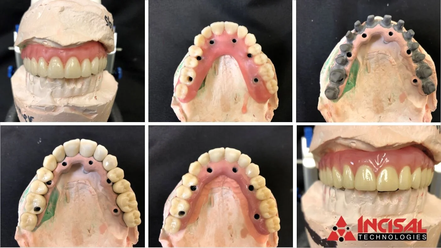 Hybrid Coping Bridge - Step by Step