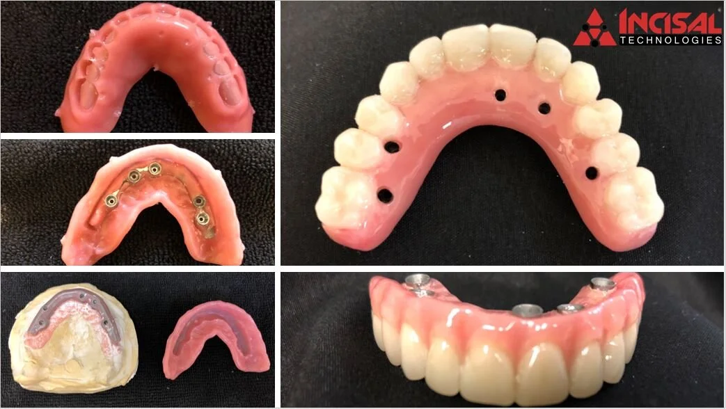 Milled Acrylic Hybrid Denture