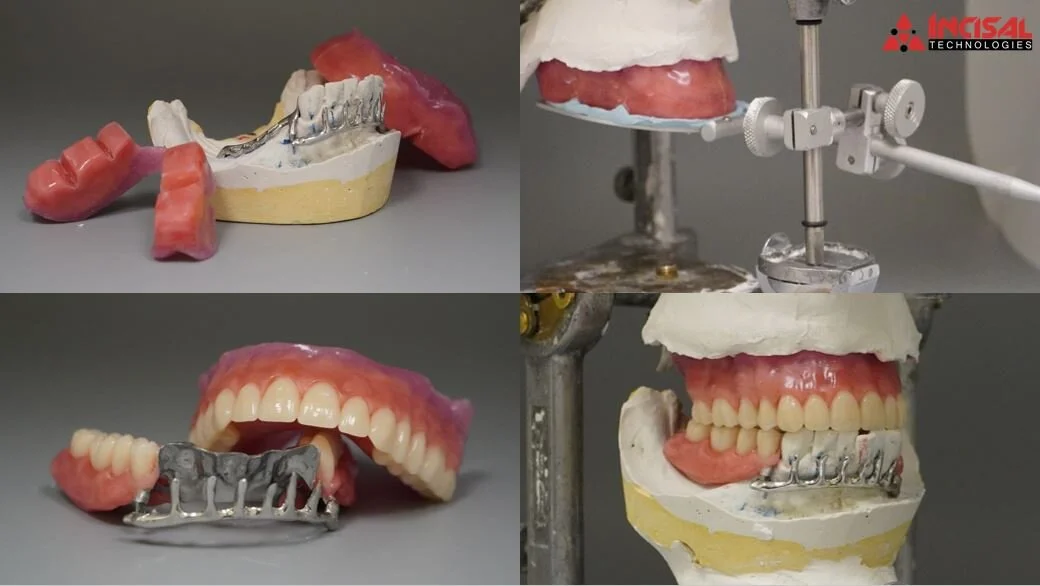 Swing-Lock Partial Denture