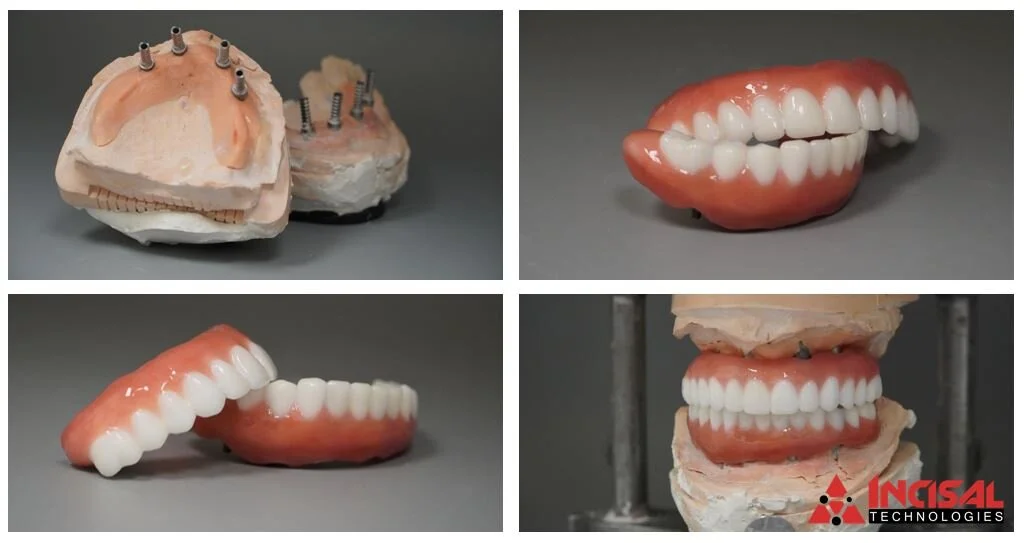 Zirconia Hybrid Dentures