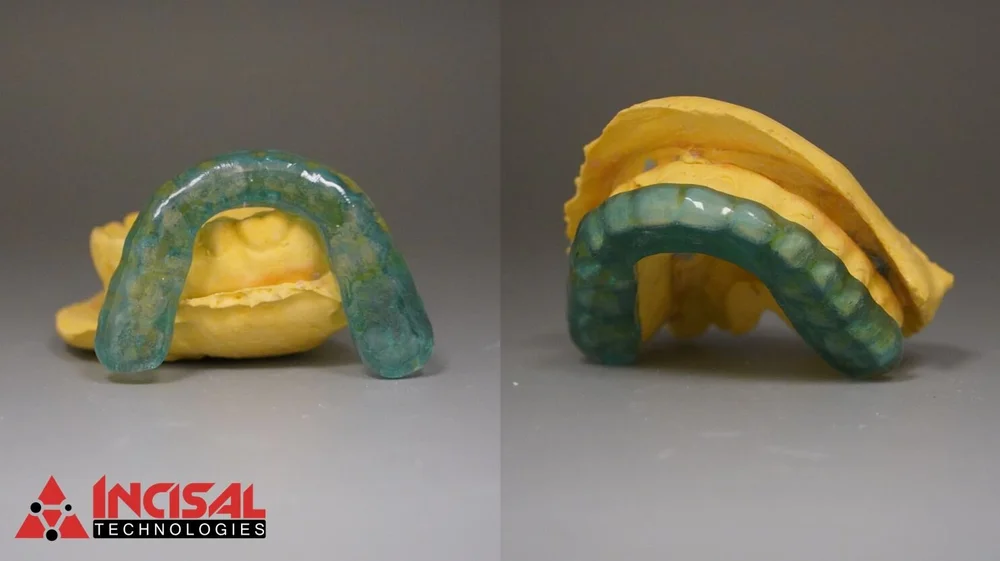 3D Printed Night Guards — Incisal Technologies Premier Dental Lab