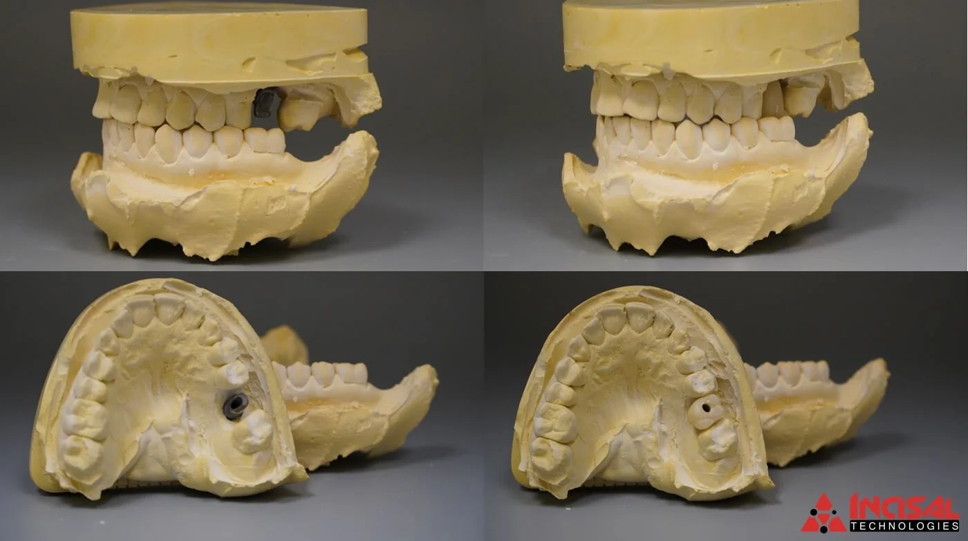 Single Implant Crown