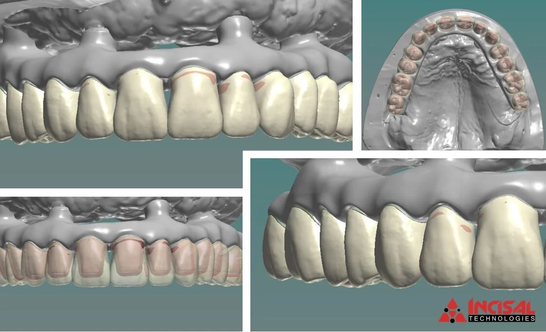 Digital Design - All-on-4 Coping Bridge