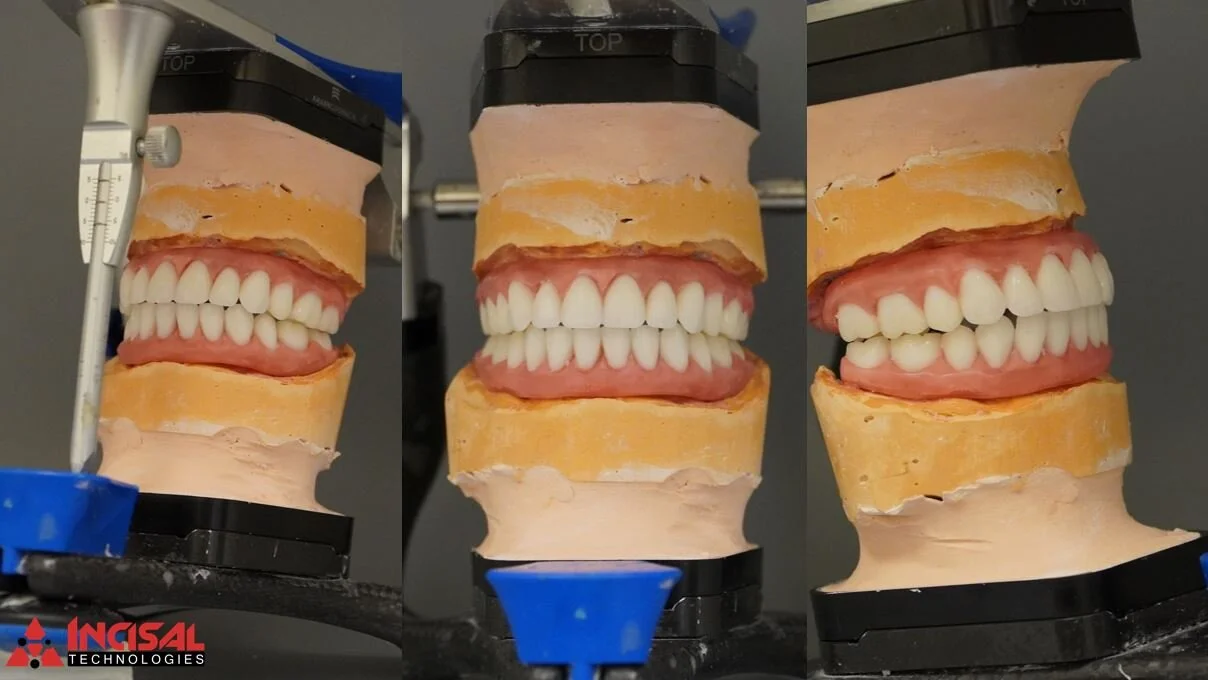 Wax-up for All-on-4 Zirconia Case