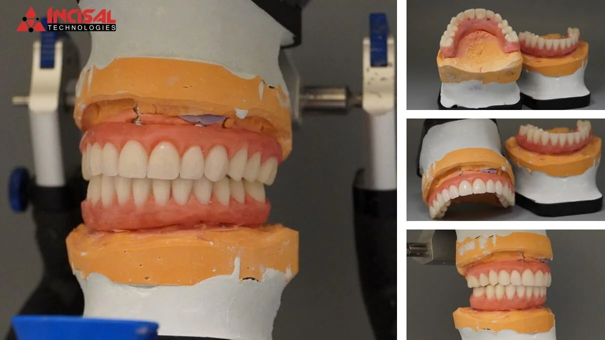 Another All-On-4 Wax-up