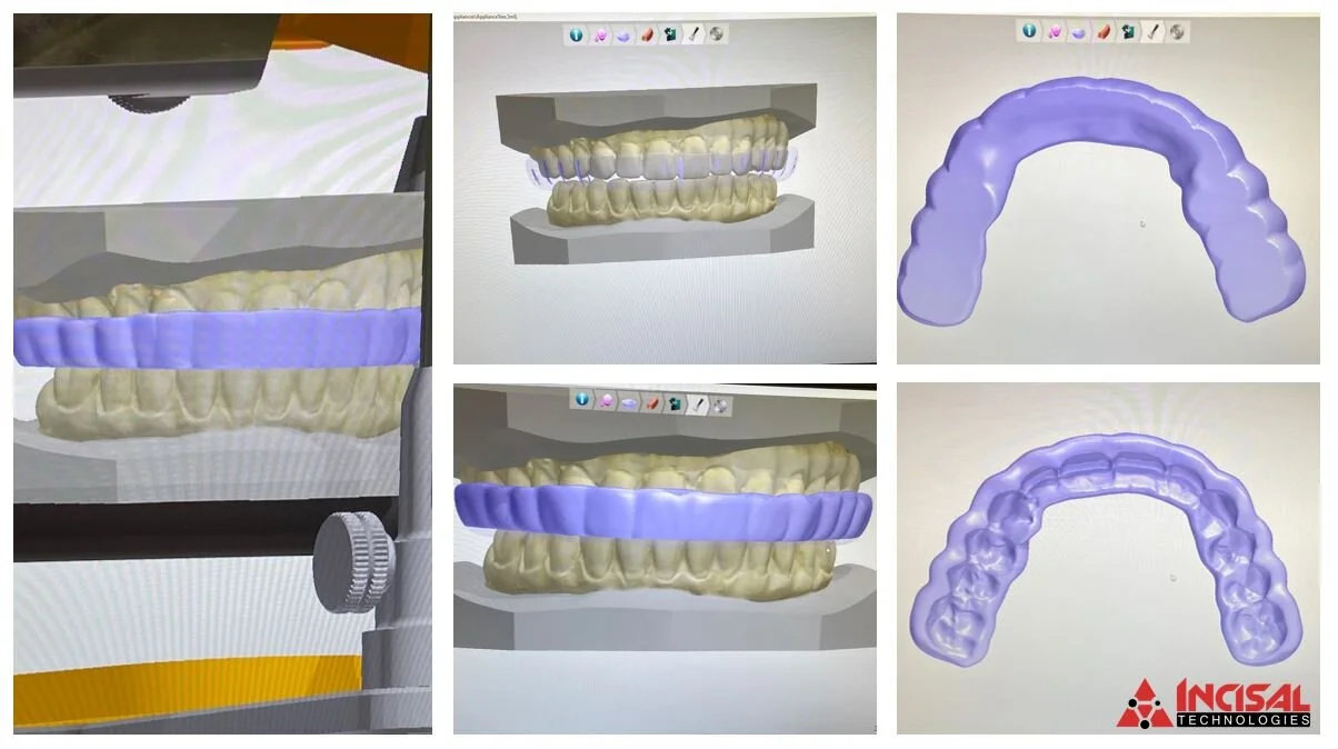 Digital Night Guard Design