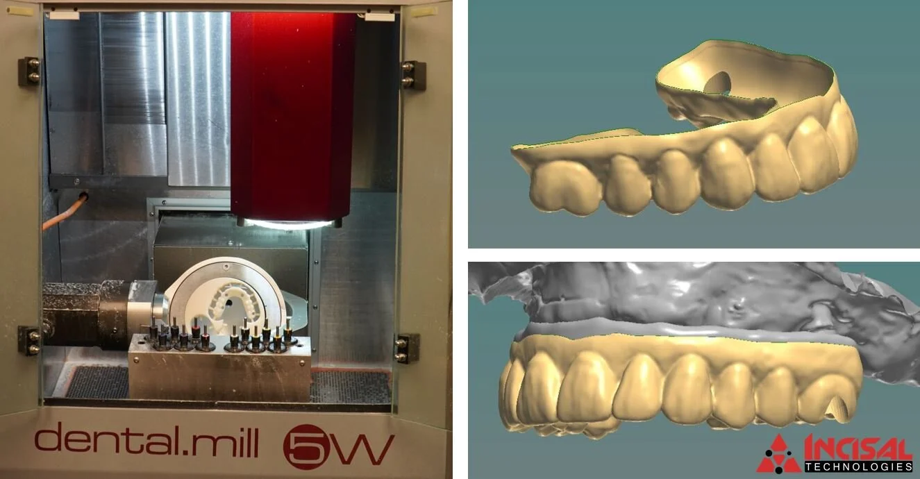 Crystal Ultra Hybrid Denture