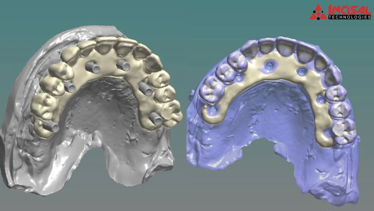 Digital Design in 3Shape