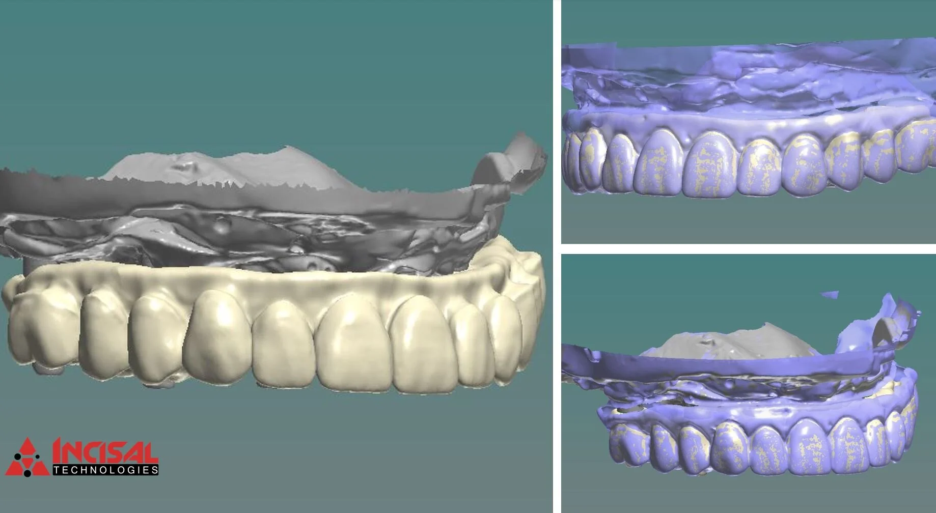 Digital Design in 3Shape