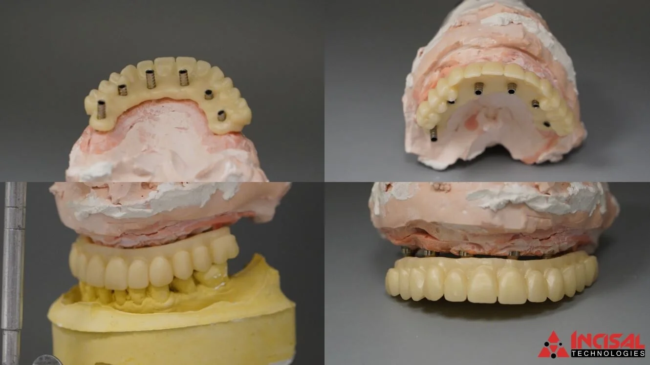 Zirconia Upper Hybrid Denture