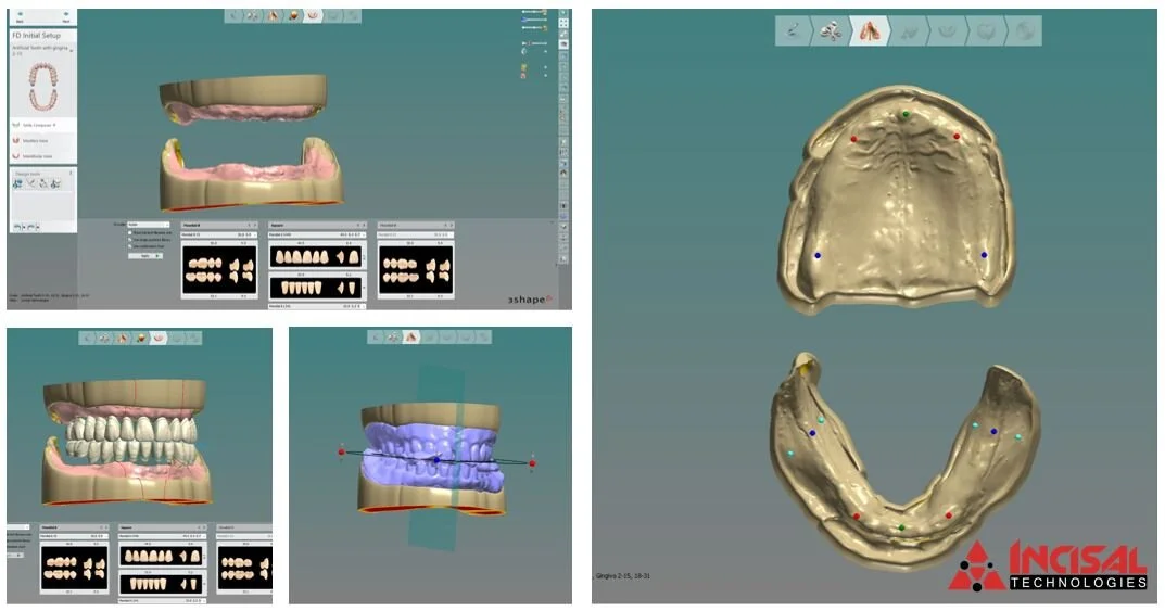 Outsourced 3D Printed Denture Design