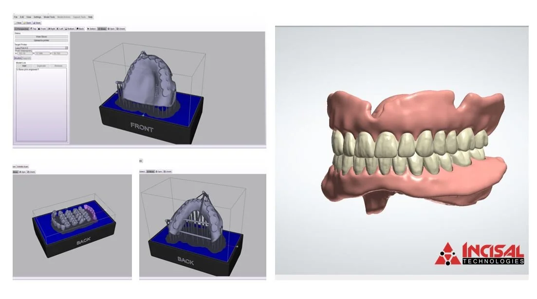 3D Printed Dentures Design