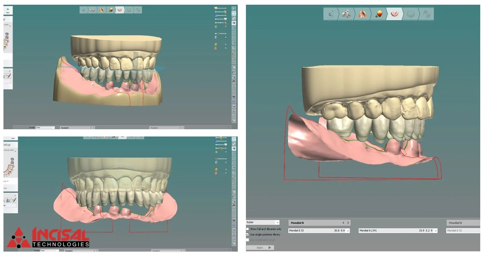 Digital Design and 3D Printing Dentures