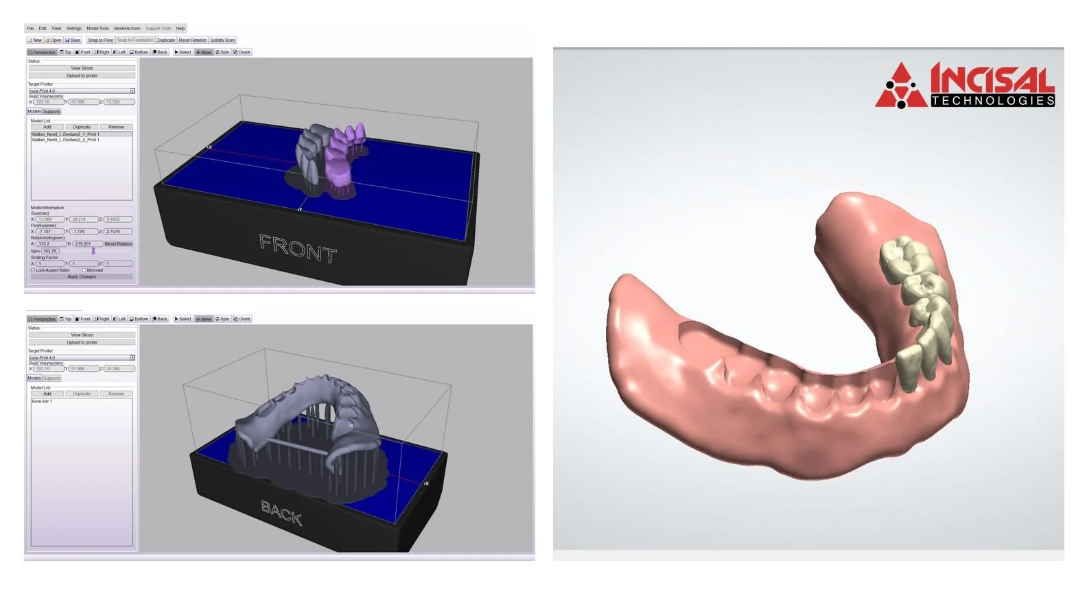 3D Printed Denture Design