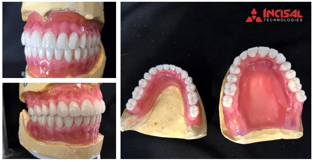 Upper and Lower Denture Wax-Up