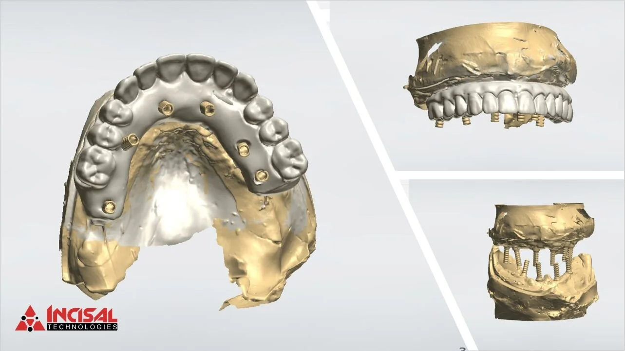 Designing a Full Mouth Restoration
