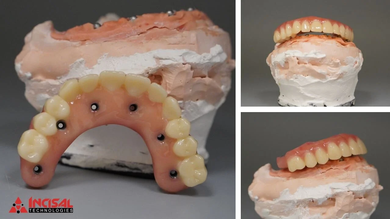 Final Upper Zirconia Hybrid Arch