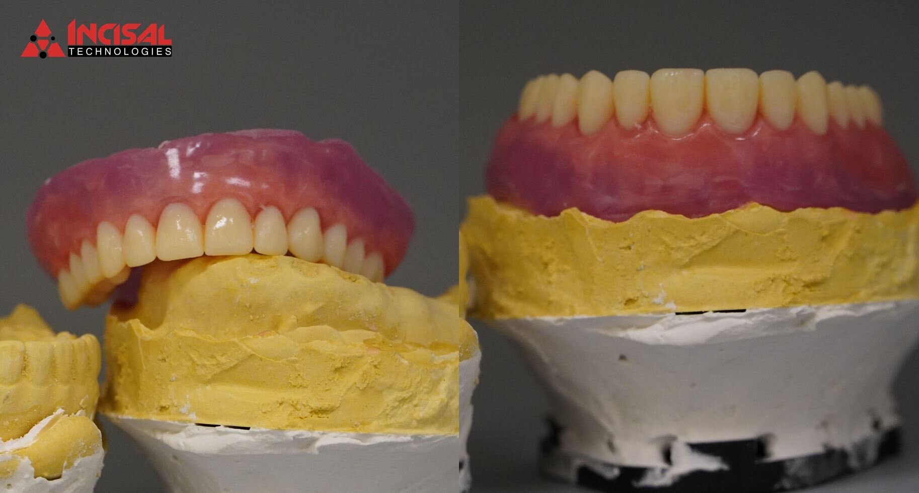 Denture Wax Up