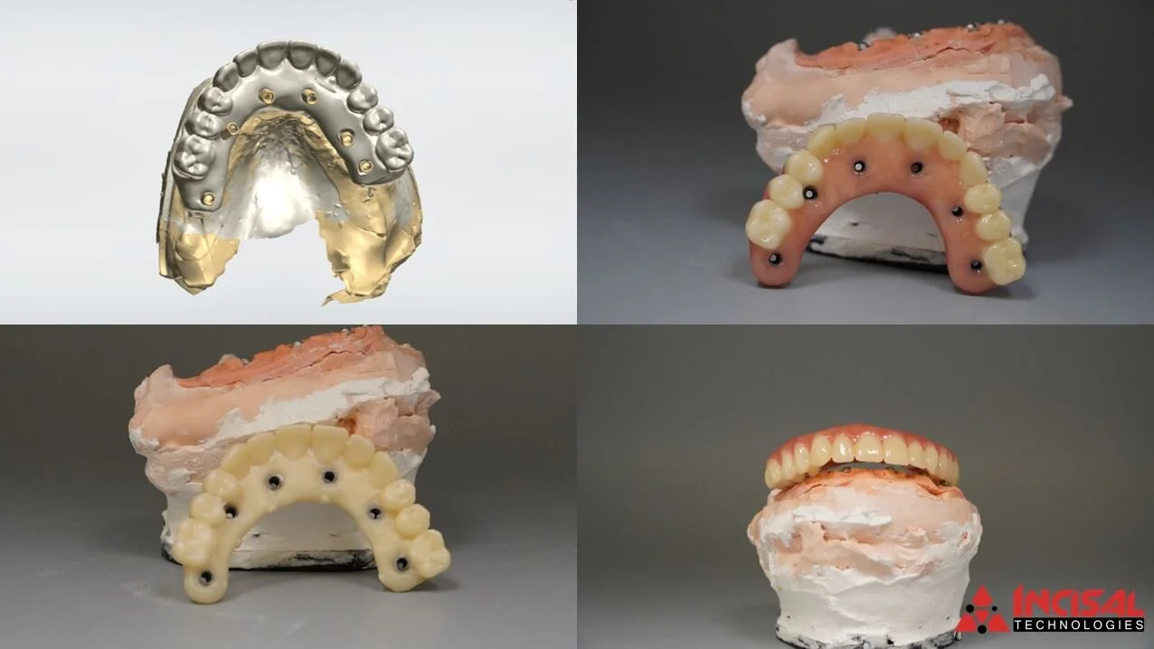 Steps to Final Zirconia Hybrid