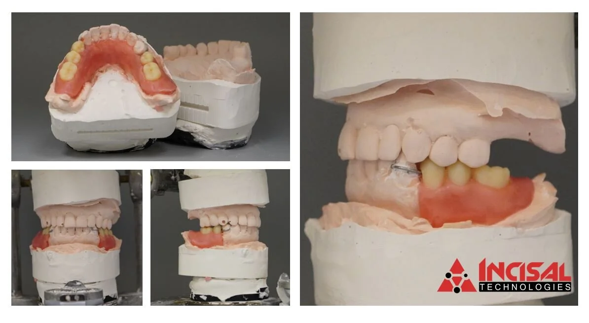 Partial Denture