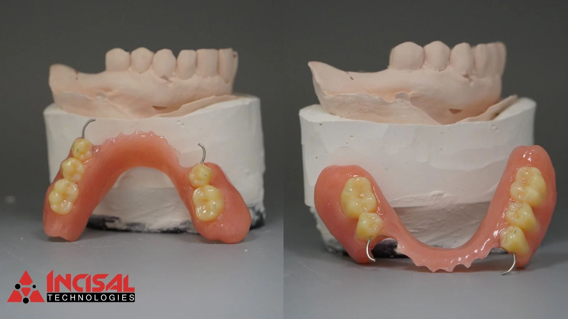 Final Partial Denture