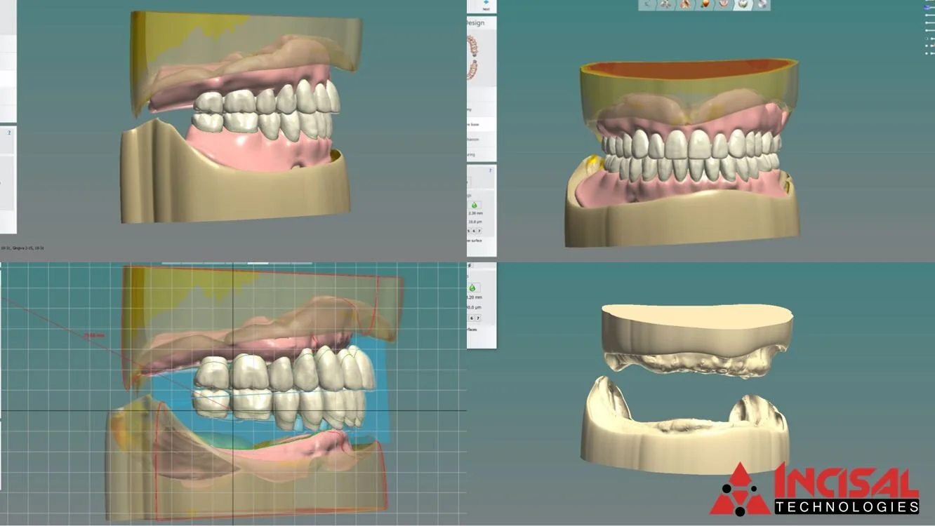Outsourced Denture Design