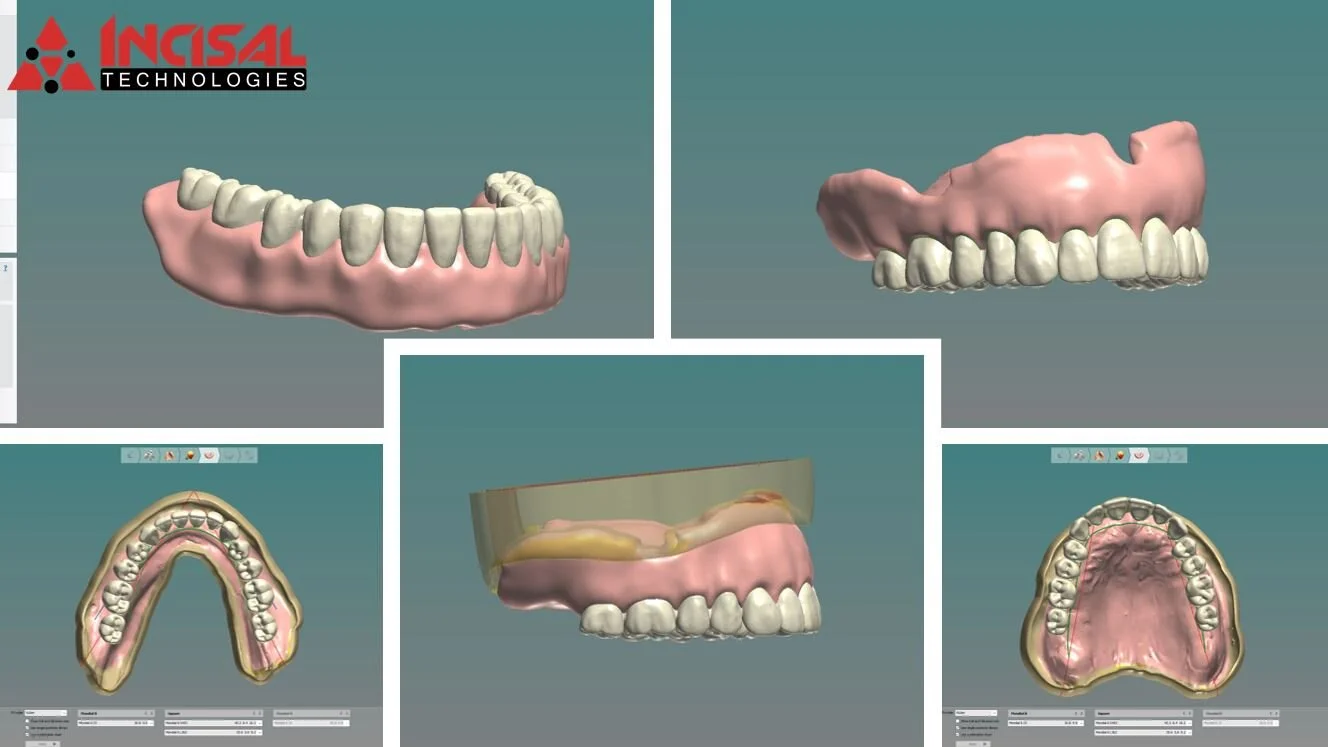 Digital Dentures