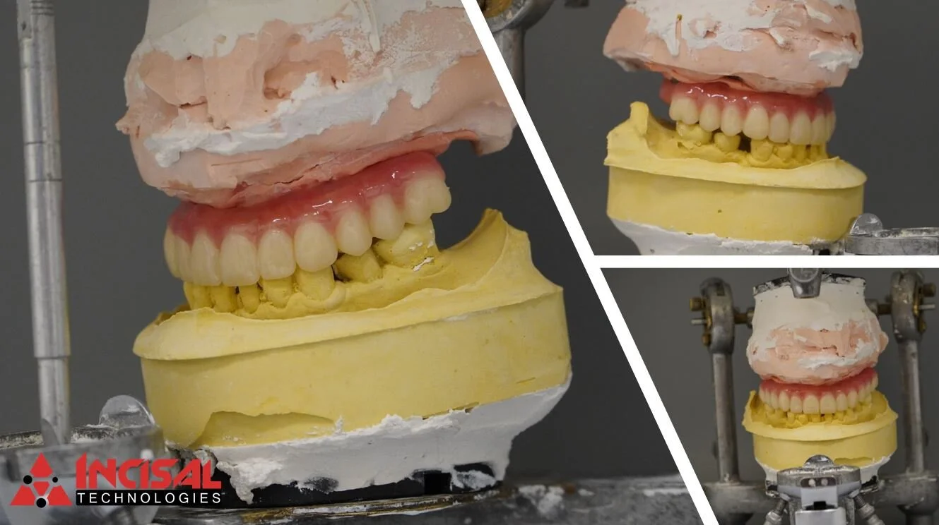 Upper Zirconia Hybrid Final