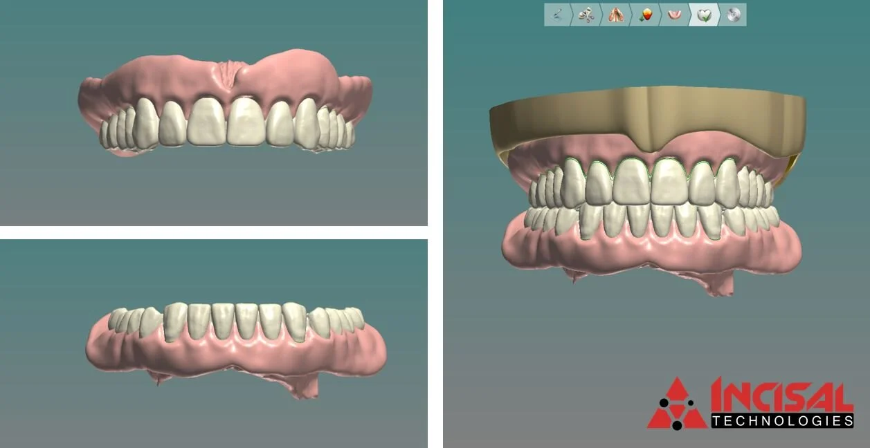 3D Printed Dentures