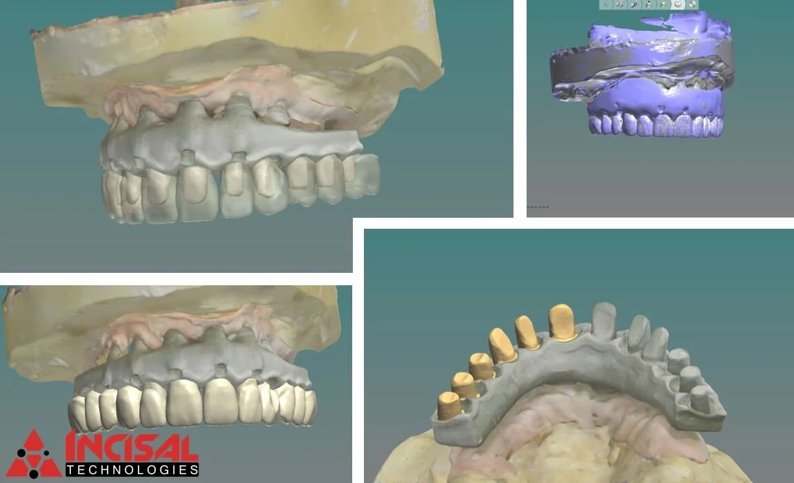 Coping Bridge Design