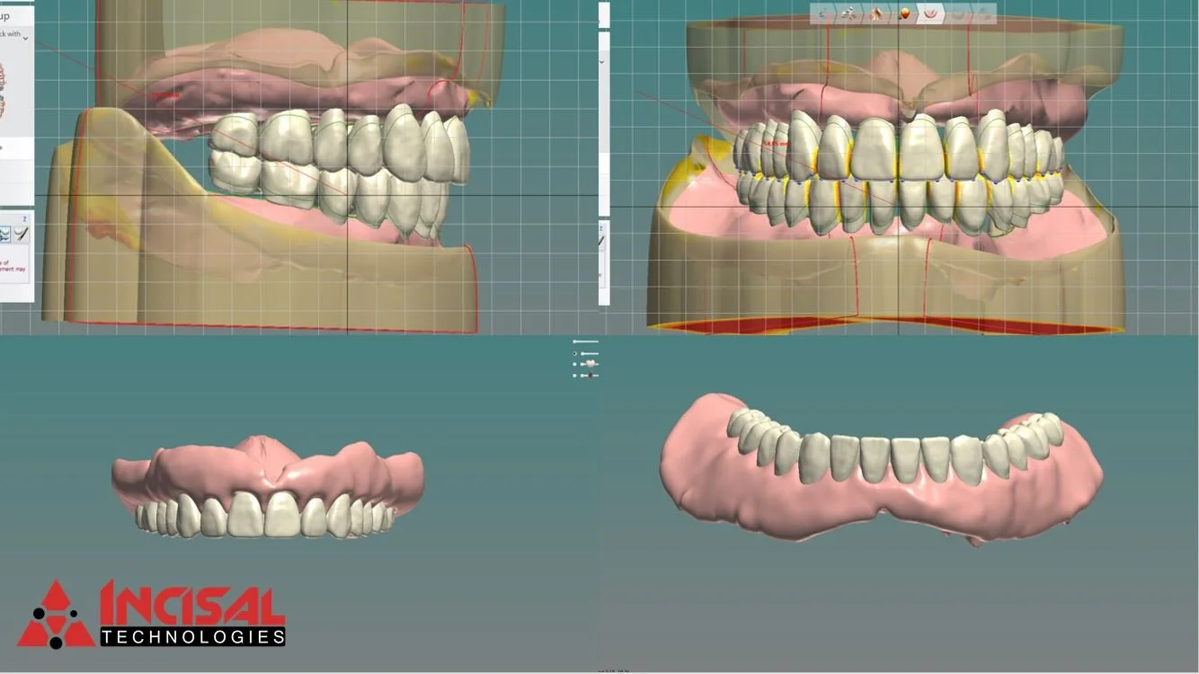 Digital Denture Design