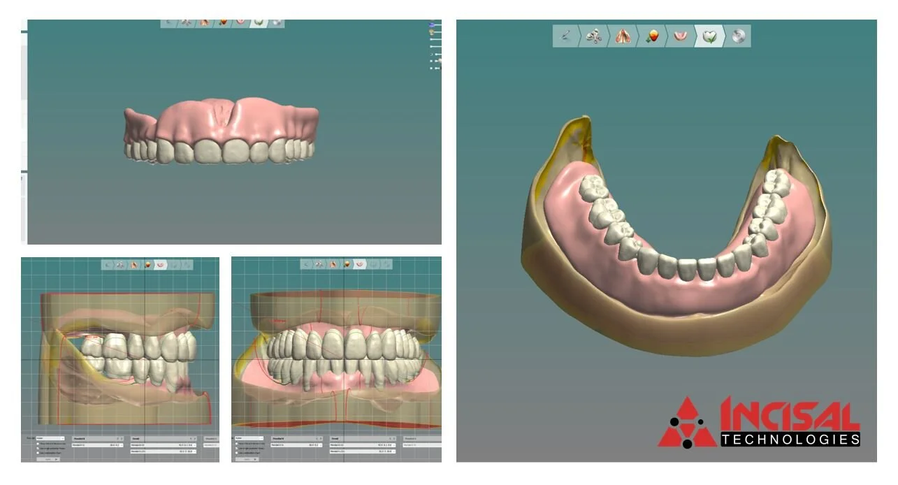 More Digital Dentures