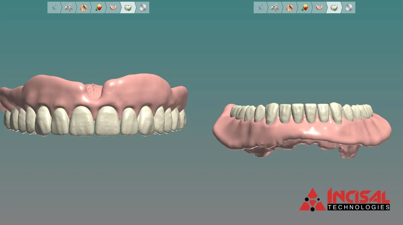 Digital Denture Design