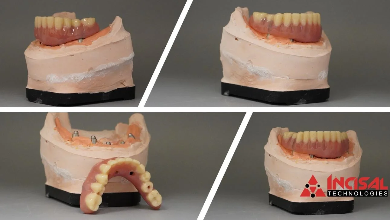 Acrylic Over Ti Bar Hybrid