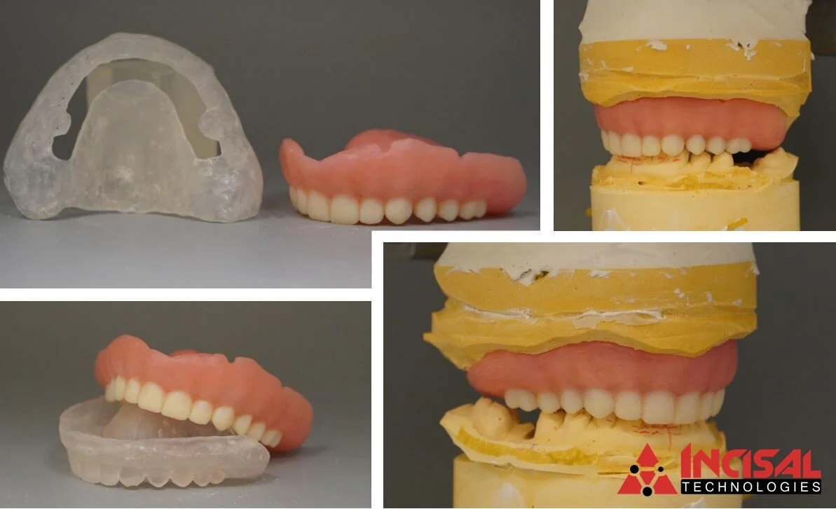Surgical Guide and Temporary Denture