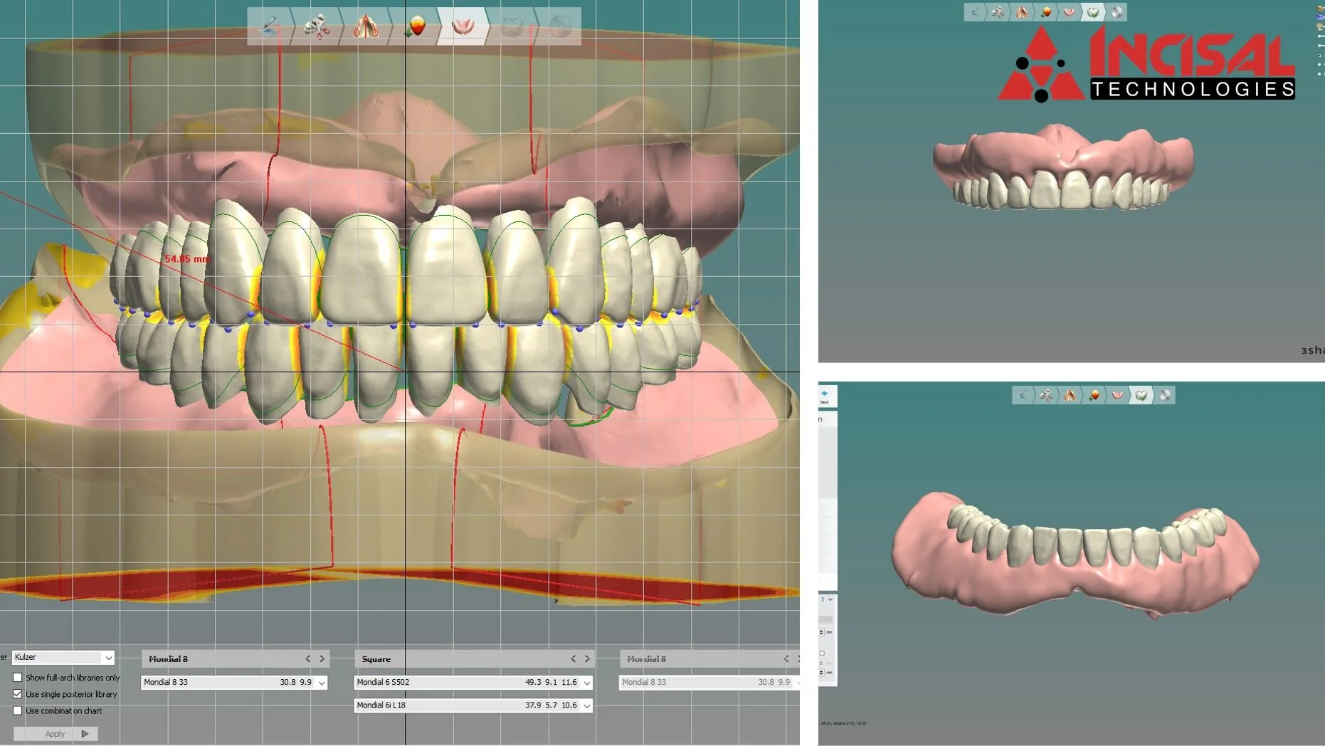 Digital Denture
